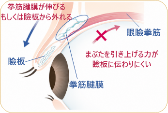 眼瞼下垂の目